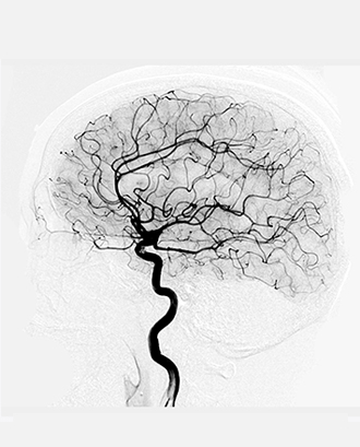 Stroke and Interventional Neurology
